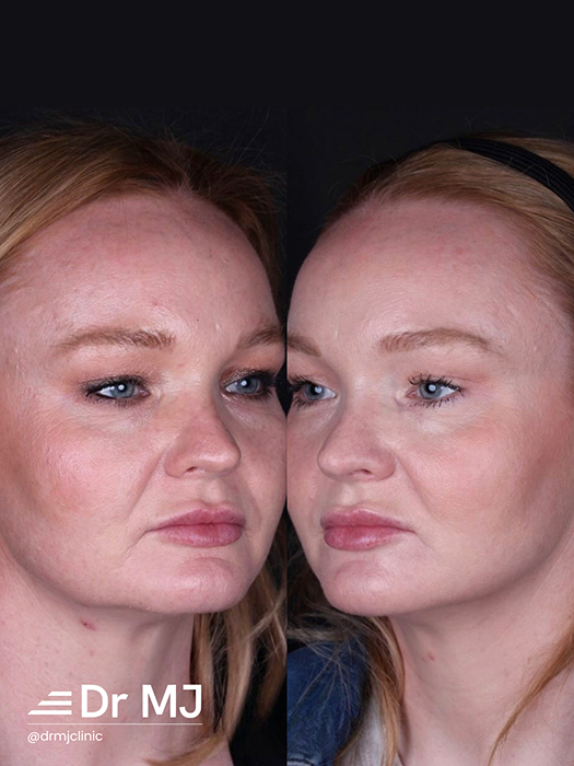 Sculptra Cost UK