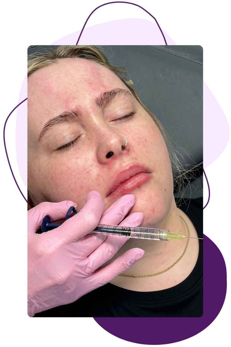 What Are Lip Fillers?